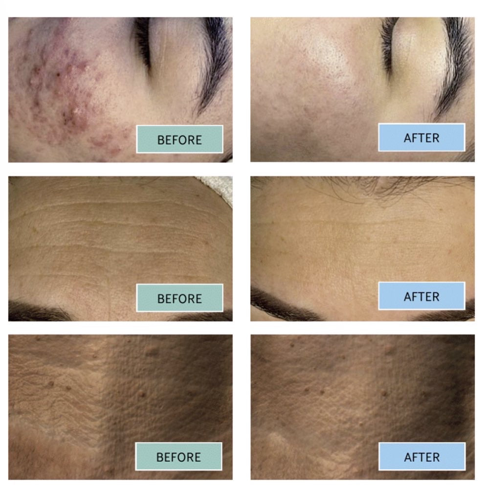 BioRepeel C3 (4 sessions)