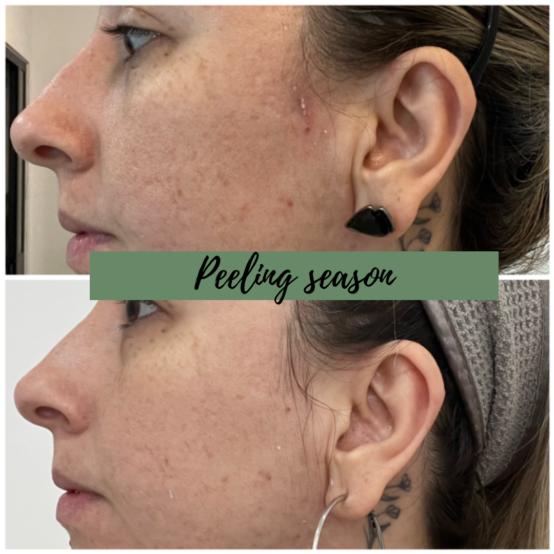 Anti Aging REGE-PEEL (6 sessions)