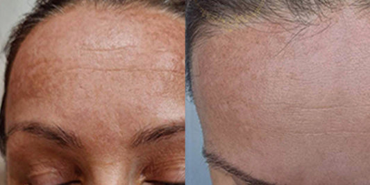 PIGMENTATION & MELASMA TREATMENT