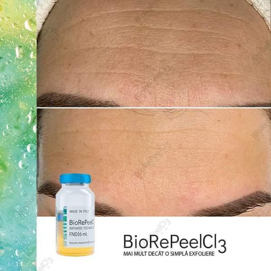 BioRePeel + LED Therapy