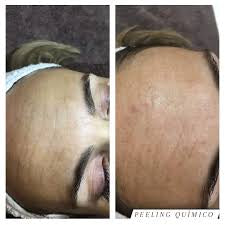 Anti Aging REGE-PEEL (6 sessions)