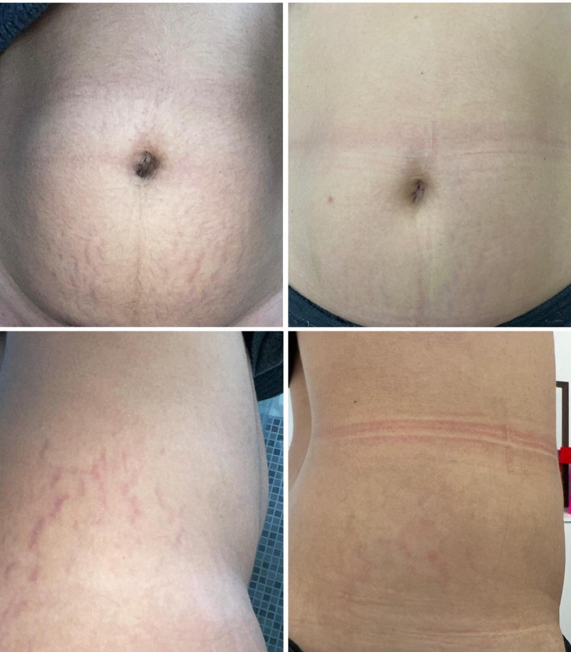 Stretch Marks Removal