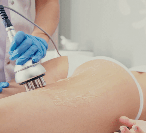 Radio Frequency Skin Tightening