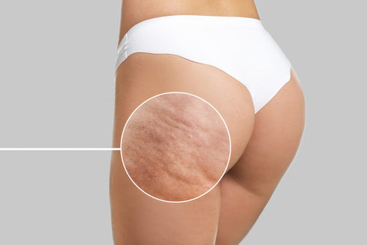 Cellulite Treatment